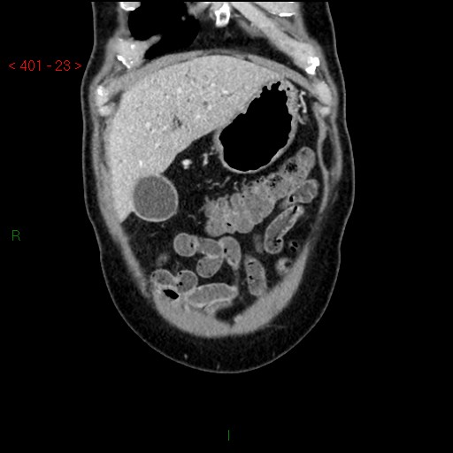 Ampullary carcinoma (Radiopaedia 56396-63056 E 22).jpg