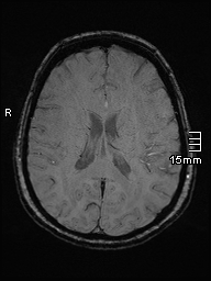 File:Amyotrophic lateral sclerosis (Radiopaedia 70821-81017 Axial SWI 32).jpg