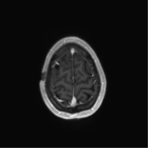 File:Anaplastic astrocytoma IDH mutant (Radiopaedia 50046-55341 Axial T1 C+ 44).png