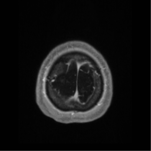 File:Anaplastic astrocytoma IDH wild-type (pseudoprogression) (Radiopaedia 42209-45276 Axial T1 C+ 138).png