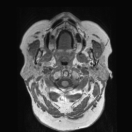 File:Anaplastic astrocytoma IDH wild-type (pseudoprogression) (Radiopaedia 42209-45278 Axial T1 11).png