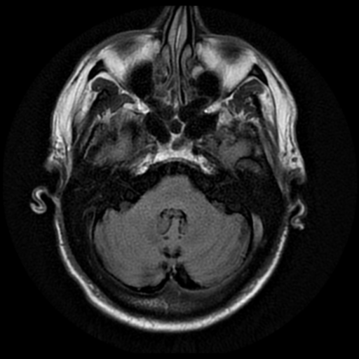 File:Anaplastic meningioma with recurrence (Radiopaedia 34452-35791 Axial FLAIR 5).png