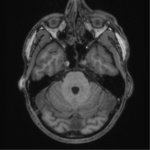 Anaplastic oligodendroglioma with skull fracture (Radiopaedia 74831-85845 Axial T1 15).png
