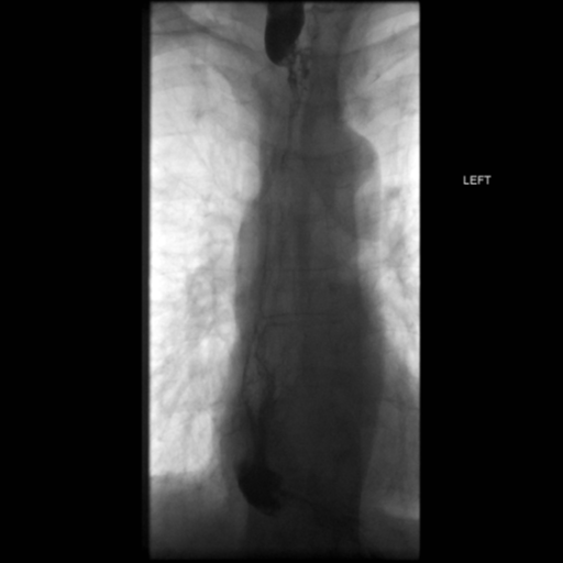 File:Anastomotic stricture post Ivor Lewis esophagectomy (Radiopaedia 47937-52715 B 37).png