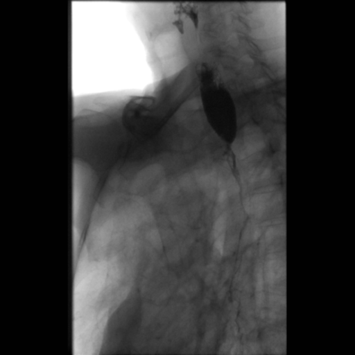 File:Anastomotic stricture post Ivor Lewis esophagectomy (Radiopaedia 47937-52715 F 4).png