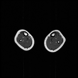 File:Aneurysmal bone cyst - tibia (Radiopaedia 22343-22367 Axial T1 1).jpg