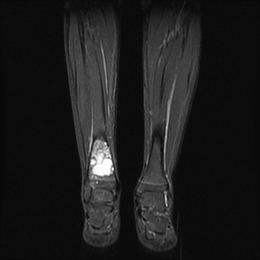 File:Aneurysmal bone cyst - tibia (Radiopaedia 22343-22367 Coronal STIR 10).jpg