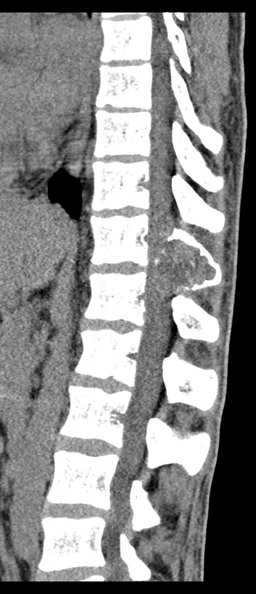 Aneurysmal bone cyst T11 (Radiopaedia 29294-29721 E 39).jpg