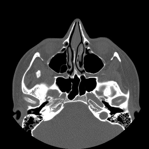 Aneurysmal bone cyst of the mandible (Radiopaedia 43280-46823 Axial bone window 148).jpg