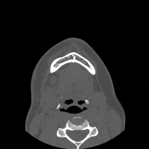 Aneurysmal bone cyst of the mandible (Radiopaedia 43280-46823 Axial bone window 17).jpg