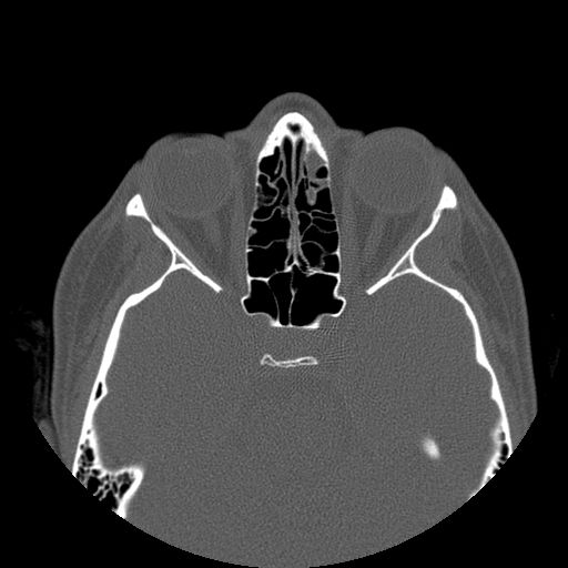 Aneurysmal bone cyst of the mandible (Radiopaedia 43280-46823 Axial bone window 173).jpg