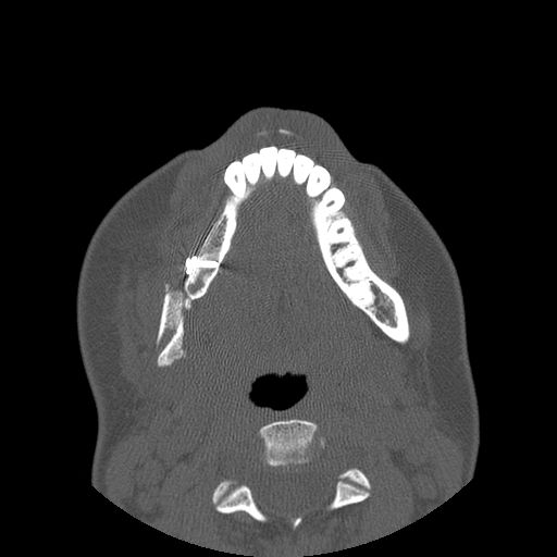 Aneurysmal bone cyst of the mandible (Radiopaedia 43280-46823 Axial bone window 51).jpg