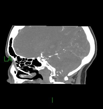 Aneurysmal subarachnoid hemorrhage with intra-axial extension (Radiopaedia 84371-99732 B 40).jpg