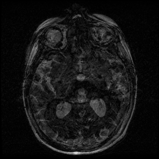 Angioinvasive aspergillosis in the pituitary fossa (Radiopaedia 39676-42010 Ax 3D FIESTA VOLUME 100).png