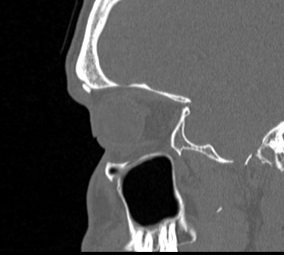 Angular epidermoid cyst (Radiopaedia 46908-51439 Sagittal bone window 16).png