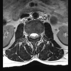 File:Ankylosing spondylitis with zygapophyseal arthritis (Radiopaedia 38433-40516 Axial T2 16).jpg
