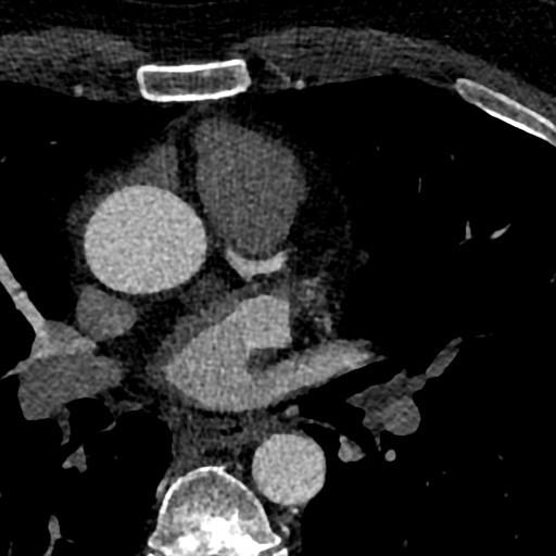 File:Anomalous origin of the left coronary artery with malignant course (Radiopaedia 77842-90126 C 14).jpeg