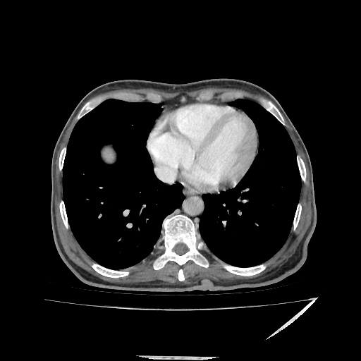 Anorectal carcinoma (Radiopaedia 44413-48064 A 2).jpg
