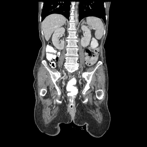 Anorectal carcinoma (Radiopaedia 44413-48064 B 55).jpg
