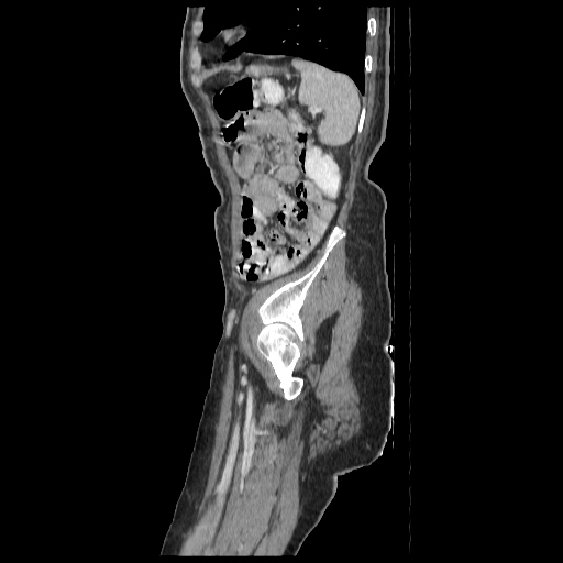Anorectal carcinoma (Radiopaedia 44413-48064 C 92).jpg