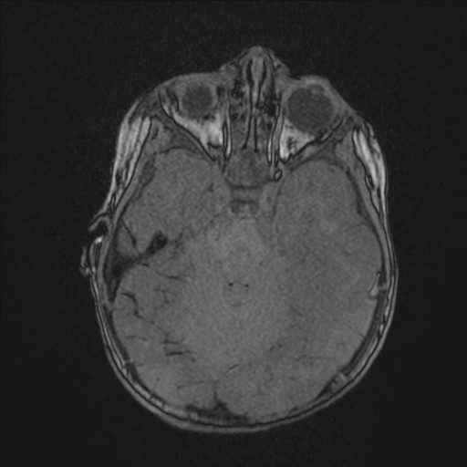Anoxic brain injury (Radiopaedia 79165-92139 Axial MRA 73).jpg