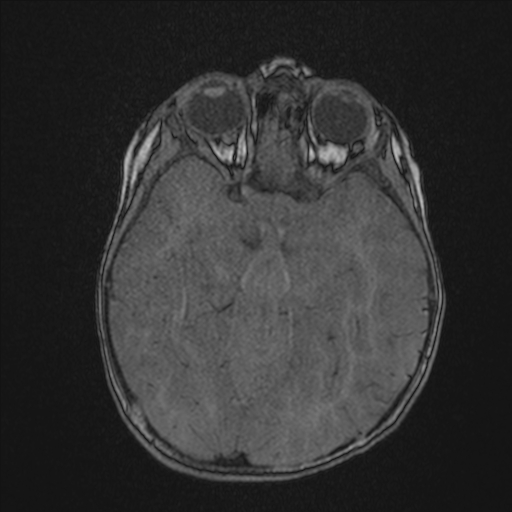 Anoxic brain injury (Radiopaedia 79165-92139 Axial MRA 88).jpg