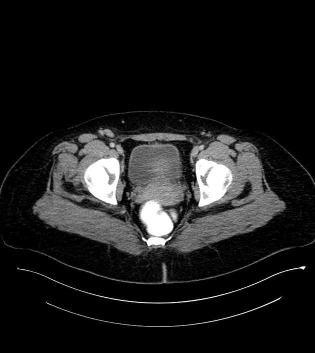 Anterior abdominal wall CSF pseudocyst (CSFoma) (Radiopaedia 79453-92571 A 85).jpg