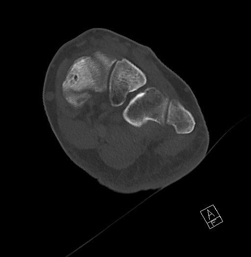 Anterior calcaneal process fracture (Radiopaedia 63353-71943 Axial bone window 82).jpg