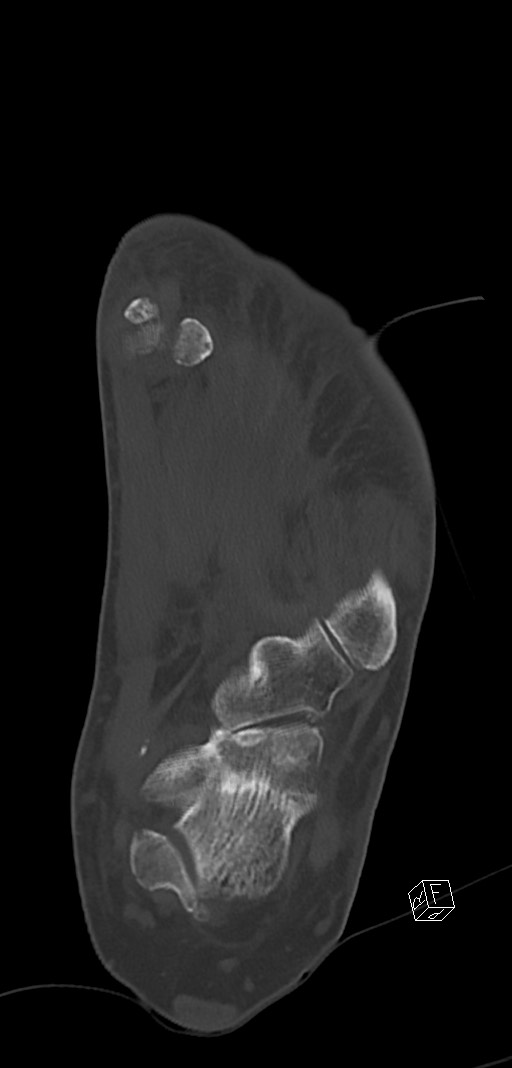 Anterior calcaneal process fracture (Radiopaedia 63353-71943 Coronal bone window 31).jpg
