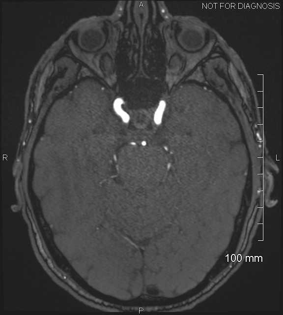 Anterior cerebral artery aneurysm (Radiopaedia 80683-94127 Axial MRA 82).jpg