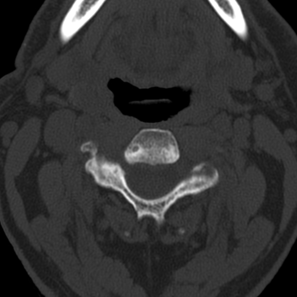 Anterior cervical postdiscectomy arthrodesis (Radiopaedia 32678-33646 Axial bone window 29).jpg