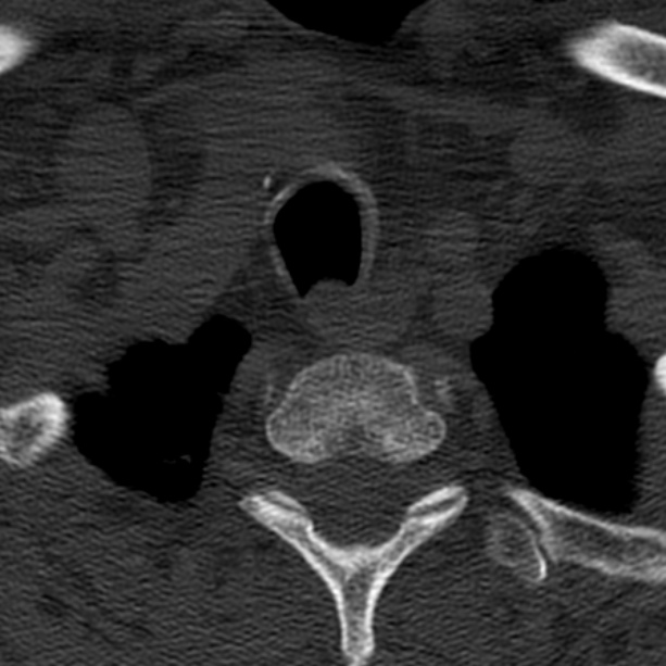 Anterior cervical postdiscectomy arthrodesis (Radiopaedia 32678-33646 Axial bone window 70).jpg