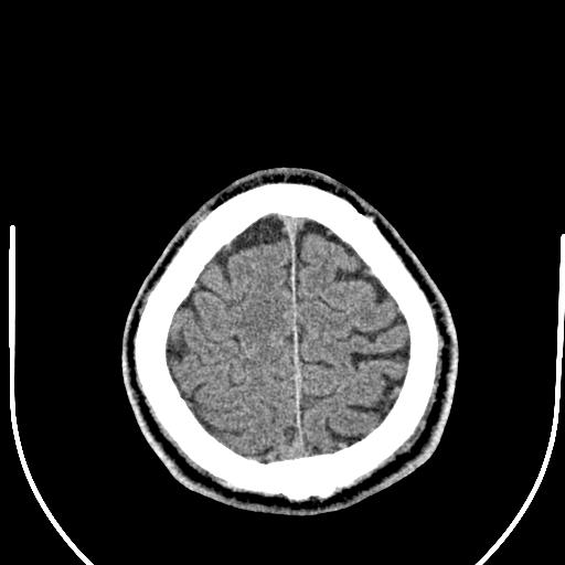 Anterior choroidal artery infarct (Radiopaedia 55106-61480 Axial non-contrast 54).jpg