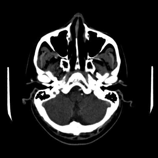 File:Anterior communicating artery aneurysm (Radiopaedia 16633-16335 A 6).jpg