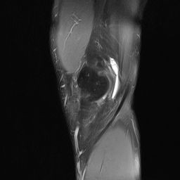 File:Anterior cruciate ligament full thickness tear (Radiopaedia 66268-75467 Sagittal PD fat sat 4).jpg