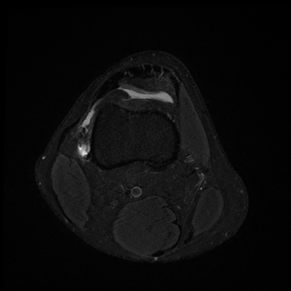 File:Anterior cruciate ligament graft tear and bucket-handle tear of medial meniscus (Radiopaedia 75867-87254 Axial PD fat sat 24).jpg