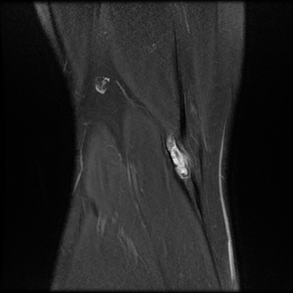 File:Anterior cruciate ligament graft tear and bucket-handle tear of medial meniscus (Radiopaedia 75867-87254 Coronal PD fat sat 24).jpg