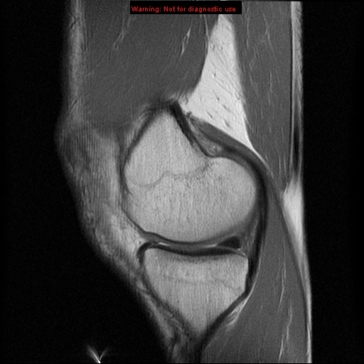 File:Anterior cruciate ligament injury - partial thickness tear (Radiopaedia 12176-12515 Sagittal PD 6).jpg