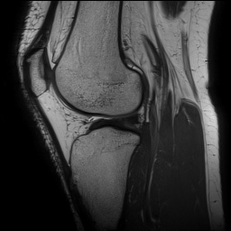 File:Anterior cruciate ligament rupture and posteromedial corner injury (Radiopaedia 67338-76723 Sagittal PD 106).jpg