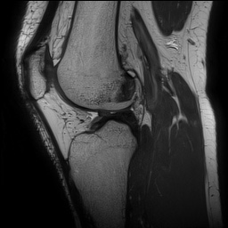 Anterior cruciate ligament rupture and posteromedial corner injury (Radiopaedia 67338-76723 Sagittal PD 98).jpg