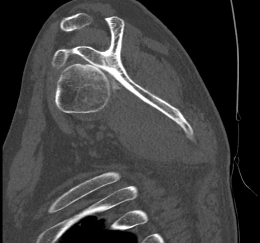 Anterior glenohumeral dislocation with Hill-Sachs lesion (Radiopaedia 62877-71249 Sagittal bone window 35).jpg