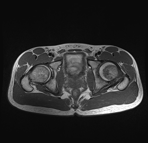 File:Anterior inferior iliac spine avulsion fracture (Radiopaedia 81312-95000 Axial T1 14).jpg