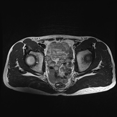 File:Anterior inferior iliac spine avulsion fracture (Radiopaedia 81312-95000 Axial T2 20).jpg