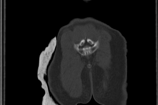 Anterior inferior iliac spine avulsion injury (Radiopaedia 88666-105376 Coronal bone window 67).jpg