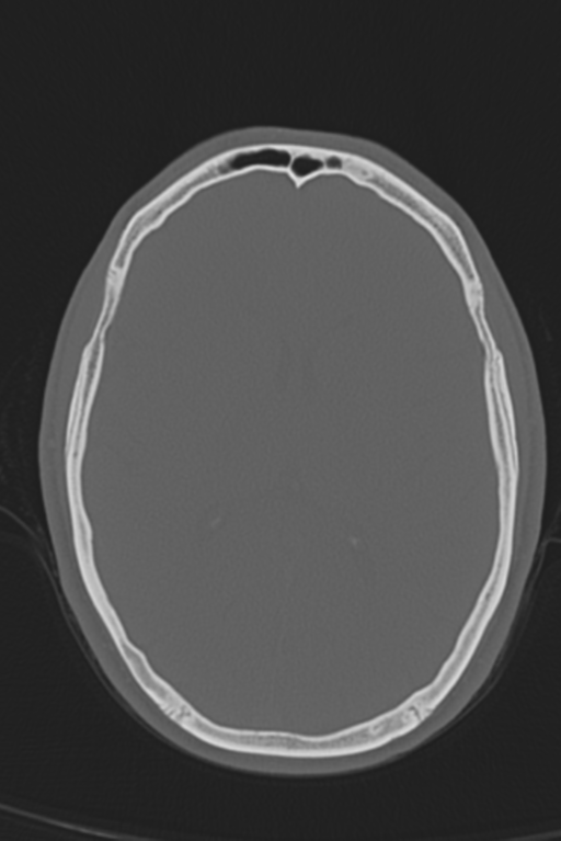 Anterior nasal spine fracture (Radiopaedia 46138-50494 Axial bone window 28).png