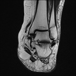 File:Anterior talofibular ligament injury - rupture with soft-tissue impingement (Radiopaedia 38765-40928 Coronal T2 15).jpg