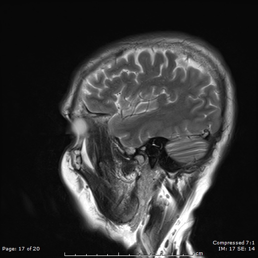 File:Anterior temporal lobe perivascular space (Radiopaedia 88283-104914 Sagittal T2 17).jpg