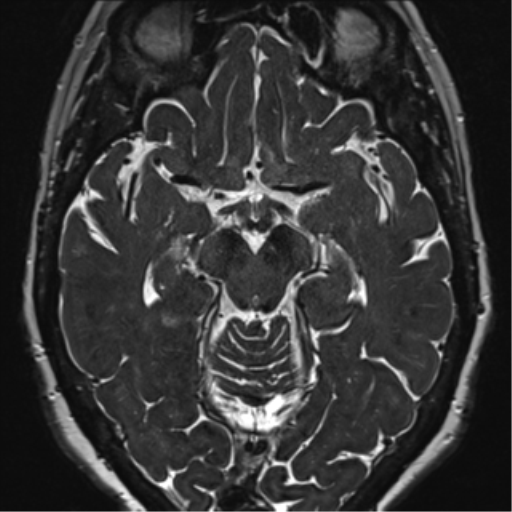 File:Anterior temporal pole cysts (Radiopaedia 46629-51102 Axial 54).png