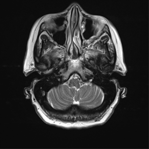 File:Anterior temporal pole cysts (Radiopaedia 46629-51102 C 7).png