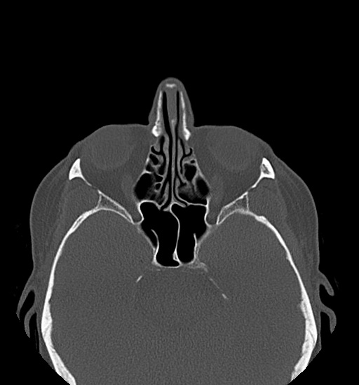 Anterior temporomandibular joint dislocation (Radiopaedia 59430-66784 Axial non-contrast 5).jpg